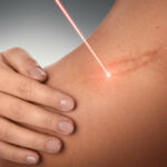 Điều trị da liễu bằng laser cần tránh vùng da nhiễm khuẩn