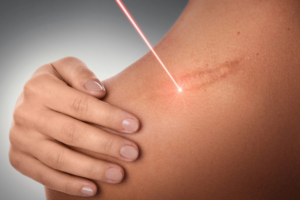 Điều trị da liễu bằng laser cần tránh vùng da nhiễm khuẩn