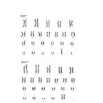 Karyotype bình thường ở nam và nữ, minh họa bộ nhiễm sắc thể hoàn chỉnh và cấu trúc tương đồng.