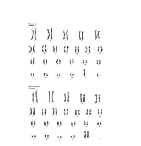 Karyotype bình thường ở nam và nữ, minh họa bộ nhiễm sắc thể hoàn chỉnh và cấu trúc tương đồng.